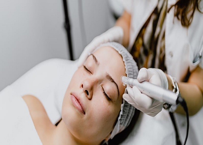 Microneedling Treatment in Clarita, CA, at Mind Body Infusion.